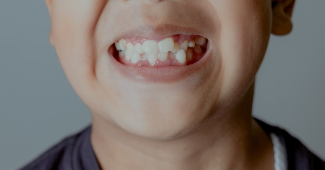 How Misaligned Teeth Affects the Quality Of Life