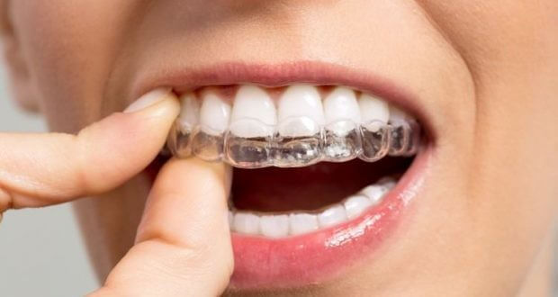 know about the Clear Correct Aligner